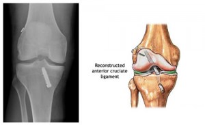 ACL-Reconstruction Surgery