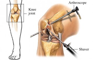 Knee Arthroscopy Surgery