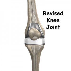 Revision-Knee-Replacement