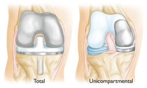 Unicompartmental-Knee-Replacement