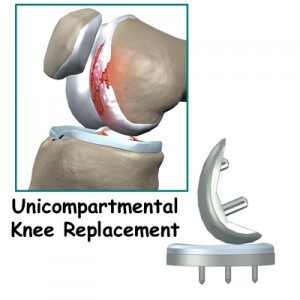 Unicondylar-Knee-Replacement-300x300