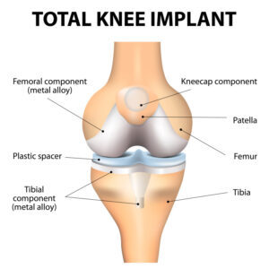 Components of a Knee Replacement