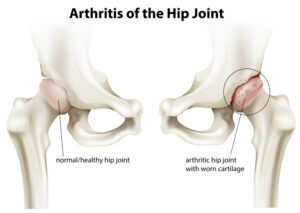 hip joint replacement
