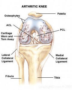 knee-replacement-surgery