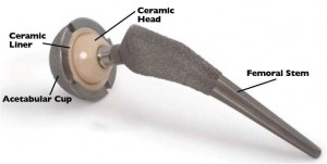 Ceramic-total-Hip-Replacements