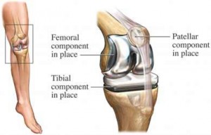 HiFlex-Knee-Replacement