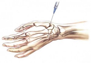 Intra-articular-Injections