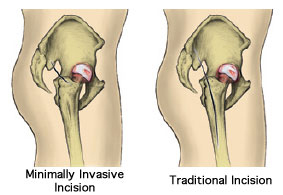 Minimally-Invasive-Total-hip-Replacement