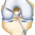 ACL Reconstruction