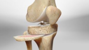 Knee Osteotomy