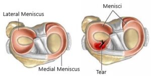 Meniscal Repair