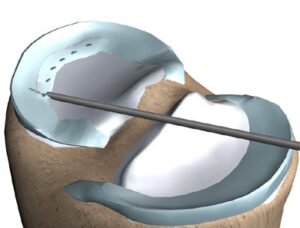 Meniscal Surgery