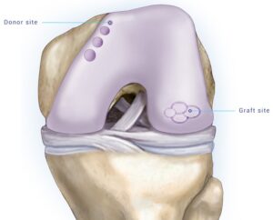 Osteochondral autograft transfer surgery