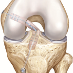 PCL reconstruction