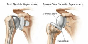 Reverse Total Shoulder Replacement