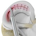 meniscal repair