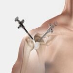 shoulder-arthroscopy-surgery