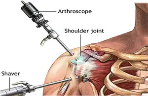 Shoulder Arthroscopy Surgery