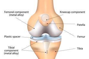 Components of a Knee Replacement